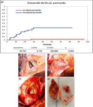 a) Curva de incidencia de insuficiencia aórtica en los que recibieron plastia pericardio frente a los que no la recibieron. LI: límite inferior; LS: límite superior. b) Válvula bicúspide con resección de fragmento calcificado. c) Reconstrucción con pericardio de válvula bicúspide. d) Degeneración de válvula bicúspide con reparación de pericardio en reimplante valvular aórtico. e) Pericardio calcificado y velo autóctono degenerado extraídos de figura c.
