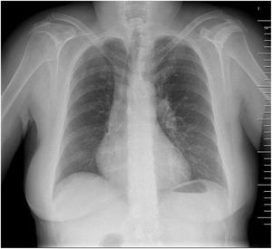 Radiografía de tórax posteroanterior al ingreso hospitalario. Se aprecia amputación del hilio derecho.