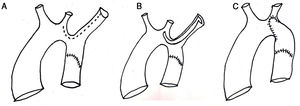 Técnica quirúrgica. A: Línea de incisión por la curvatura mayor del arco. B: Incisión de la subclavia y a lo largo del arco y la carótida. C: Aspecto final de la ampliación.