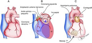Esquema del procedimiento del reemplazo aórtico (Ross-Konno) y del mitral (Melody®). A. Las líneas negras discontinuas muestran el sitio de las arteriotomías aórtica y pulmonar. B. Las líneas negras discontinuas indican el sitio de la incisión del Konno y los tractos de salida del VD/VI. C. Vista final del procedimiento.
