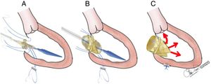 A. Válvula Melody® montada en el balón de despliegue, colocada en posición mitral; se muestran los puntos (cardinales) de fijación al anillo mitral nativo. B. Inflado del balón y despliegue de la Melody®. C. Anudado de los 4 puntos de fijación de la válvula Melody® al anillo mitral y del punto de fijación externa, comprobando que el TSVI quede libre de obstrucción.