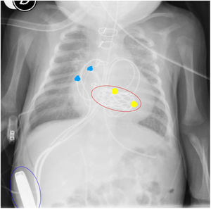 Radiografía toracoabdominal donde se observa la válvula Melody® en posición mitral (óvalo rojo), electrodos epicárdicos de contacto en aurícula derecha (puntos azules), electrodos epicárdicos de contacto en VD (puntos amarillos) y generador de marcapasos bicameral en bolsillo paralumbar derecho retromuscular (óvalo azul).