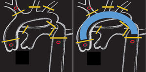 Posición de pinzas y/o torniquetes en (barras amarillas): aorta ascendente y descendente, base de los 3 troncos supraaórticos, ductus y ramas pulmonares. La canulación selectiva de la raíz aórtica, arteria innominada y aorta descendente (círculos en rojo) permite una perfusión corporal total. Solo el arco aórtico permanence exangüe (imagen derecha).