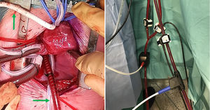 A: Imagen de campo mostrando canulación selectiva de la arteria innominada a través de PTFE (flecha vertical) y aorta descendente (flecha horizontal) junto a vena cava inferior. B: Medidores de flujo en drenaje venoso (manguito azul) y ambas ramas de la línea de retorno arterial (en rojo).
