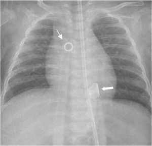 Rx de tórax en neonato con asistencia univentricular tipo Berlin Heart EXCOR. Cánula apical (flecha gruesa). Cánula aórtica (flecha delgada).