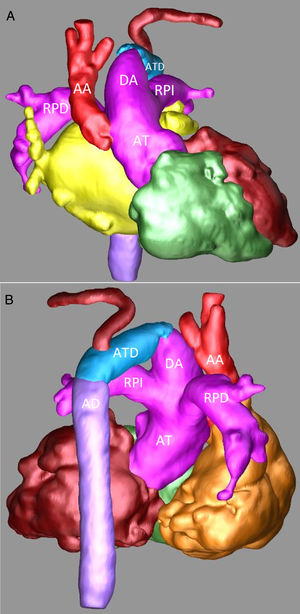 Angiotomografía: A) Reconstrucción tridimensional, proyección anterior en la que se observa de forma detalla la AT, el gran DA, una pequeña AA y la IAA. B) Reconstrucción tridimensional, proyección posterior en la que se observan la continuidad del DA con el ATD y la AD. AA: aorta ascendente. AD: aorta descendente. AT: arteria truncal. ATD: arco transverso distal. DA: ductus arterioso. RPD: rama pulmonar derecha. RPI: rama pulmonar izquierda.