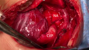 Visión del campo quirúrgico luego de la corrección. CVP: conducto ventrículo-pulmonar. NA: Neoaorta. VD: ventrículo derecho.