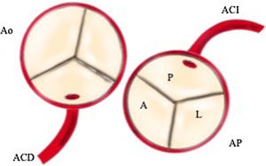 Esquema de ALCAPA con arteria coronaria izquierda naciendo del seno posterior. A: seno anterior de arteria pulmonar; ACD: arteria coronaria derecha; ACI: arteria coronaria izquierda; Ao: aorta; AP: arteria pulmonar.