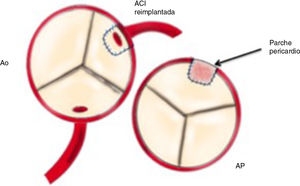 Esquema de ALCAPA reimplantada en la aorta y reconstrucción de la arteria pulmonar con parche de pericardio autógeno. ACI: arteria coronaria izquierda; Ao: aorta; AP: arteria pulmonar.
