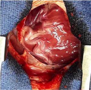 Imagen intraoperatoria de ALCAPA. Se identifica rama de arteria coronaria derecha dilatada.