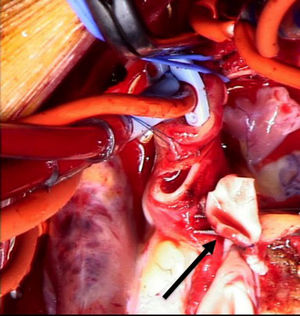 Imagen intraoperatoria de ALCAPA. La flecha negra señala el botón coronario izquierdo ampliado con tejido de arteria pulmonar autógeno.