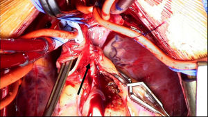 Imagen intraoperatoria de ALCAPA. La flecha negra señala la arteria coronaria izquierda reimplantada en la aorta.