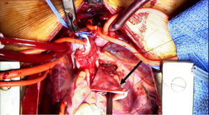 Imagen intraoperatoria de ALCAPA. La flecha negra señala la arteria pulmonar reconstruida con parche de pericardio autógeno.