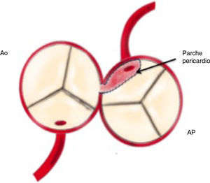 Esquema de ALCAPA reparado con técnica de Takeuchi. Ao: aorta; AP: arteria pulmonar.