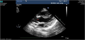 Caso clínico 2. Imagen ecocardiográfica del TSVI tras la cirugía de Ross-Konno con autoinjerto normofuncionante y ausencia de datos obstructivos en TSVI.