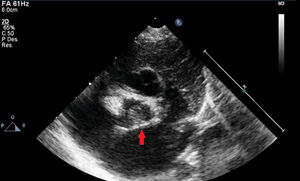 Anatomía valvular aórtica por imagen ecocardiográfica. Válvula funcionalmente monocúspide con única comisura con adecuada apertura a nivel posterior (flecha).