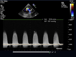 Gradiente pico por Doppler color a través de la válvula aórtica.