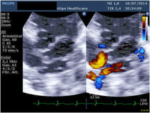Imagen ecocardiográfica preoperatoria en la que se observa el colector con la llegada de las venas pulmonares y sin comunicación con la aurícula izquierda.