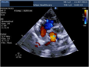 Imagen ecocardiográfica intraoperatoria en la que se observa la conexión quirúrgica amplia entre el colector y la aurícula izquierda.