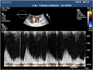 Imagen ecocardiográfica en la que se objetiva ausencia de obstrucción significativa entre el colector y la aurícula izquierda.