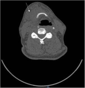 Corte axial de tomografía cervical con evidencia de un absceso submandibular derecho (señalado por la flecha).
