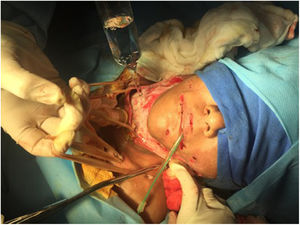 Abordaje cervical extenso bilateral para drenaje de absceso.