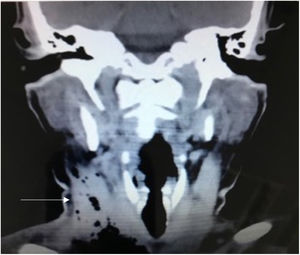 Corte coronal de tomografía de base de cráneo y cuello con evidencia de gas en espacio parafaríngeo. La flecha señala el absceso.