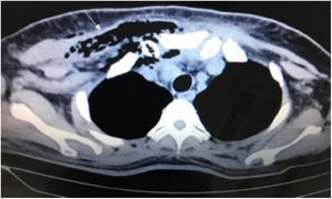 Corte axial de tomografía con evidencia de mediastinitis. La flecha señala la presencia de gas y una colección mediastínica.