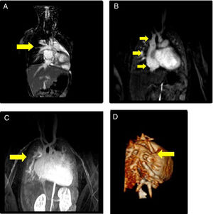 Imágenes de resonancia magnética (A-C son cortes sagitales): A) Arteria pulmonar. B) Vena cava superior, aurícula derecha y vena cava inferior. C) Desembocadura de venas pulmonares (VVPP) anómalas a vena cava superior. D) Reconstrucción tridimensional de la llegada de las VVPP anómalas a vena cava superior.