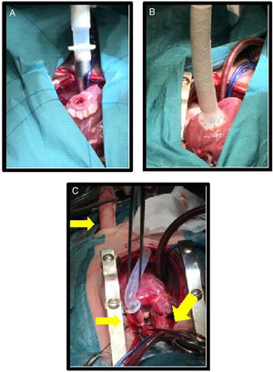 Esternotomía media, imágenes intraoperatorias: A) Orificio en ápex del ventrículo izquierdo para colocar cánula 9/12mm de Berlin-Heart Excor®. B) Cánula del ventrículo izquierdo insertada. C) Reparación DVPAP (Warden modificado) e implante de cánula 6mm en aorta con clampaje aórtico parcial.