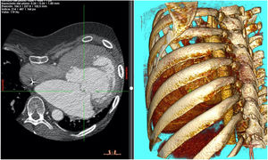 Se aprecia pectus excavatum y desviación de estructuras cardíacas a hemitórax izquierdo.