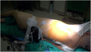 Decúbito lateral derecho con pelvis ligeramente rotada hacia la izquierda.