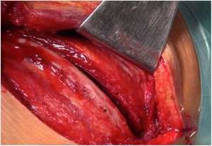 Toracotomía posterolateral por quinto espacio intercostal.