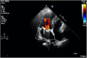 Normoposición de la válvula sin apreciarse ningún tipo de fuga en ecocardiografía transesofágica de control a los 20 meses de la cirugía.