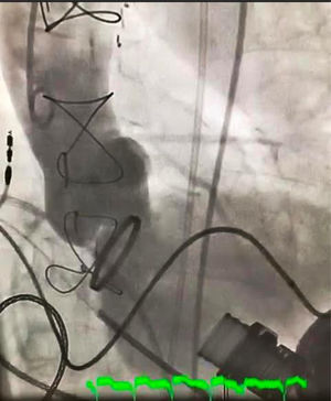 Aortografía previa al implante de la TAVI. Se observa el relleno del ventrículo izquierdo, debido a la IA severa.