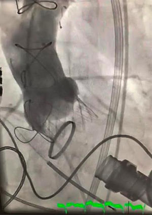 Aortografía tras el implante de la TAVI. No se observa IA significativa.