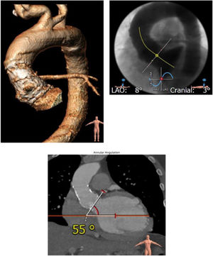 Planeación preoperatoria evaluando los diámetros de toda la aorta con la angiotomografía computarizada.