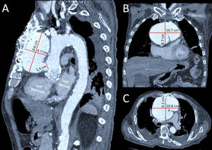 A-C) AngioTEM con vista en tres planos del PAA y sus respectivas mediciones (sagital, coronal y transversal).