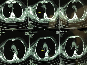 Identificación del clavo de Steinmann hasta la perforación de la aorta.