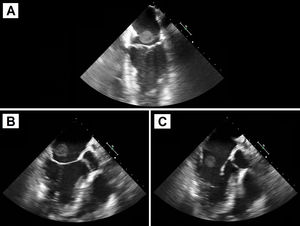 Ecocardiografía transesofágica preoperatoria. A: Plano longitudinal de 2 cámaras. B y C: Plano transversal de 5 cámaras. Se aprecia la masa de gran tamaño anclada al dispositivo de cierre de FOP, en la vertiente auricular izquierda, que protruye hacia la válvula mitral.