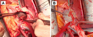 Fotografías del campo quirúrgico. A: Atriotomía derecha para acceso al septo interauricular donde se encuentra anclado el dispositivo de cierre de FOP. Resección del dispositivo objetivando en la vertiente auricular izquierda un absceso adherido. B: Dispositivo de cierre de FOP con endotelización incompleta en ambas vertientes, ya excluido del septo interauricular.