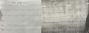 ECG showing reversion of a CHB with narrow complex escape rhythm to a normal sinus rhythm.