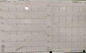 ECG showing narrow complex escape rhythm in a CHB.