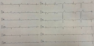 ECG showing narrow complex escape rhythm with a RBBB pattern escape morphology and intermittent VPCs.