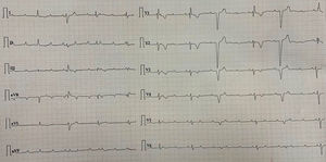 ECG showing narrow complex escape rhythm with a RBBB pattern escape morphology and intermittent VPCs.