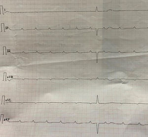 ECG showing wide complex escape rhythm with extremely low ventricular escape rate.