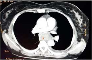Angiotomografía de tórax. Flecha: se evidencia colección periesofágica.
