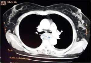 Angiotomografía de tórax. Flecha: se evidencian cambios en la pared aórtica.