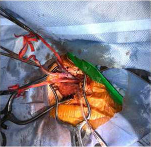 Canulación axilar arterial.