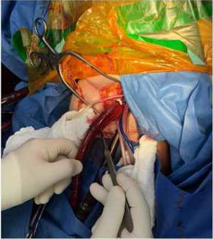 Canulación femoral derecha arterial.